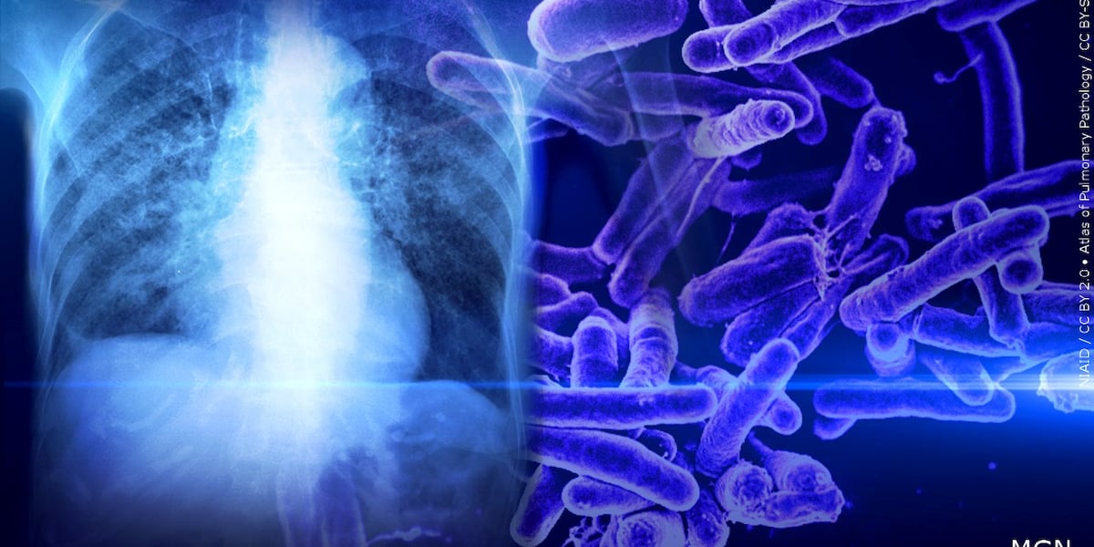 Initial test results returned after possible tuberculosis exposure at
